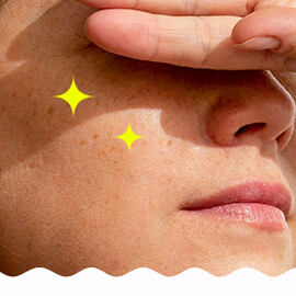 Mitesszerek, pórusproblémák