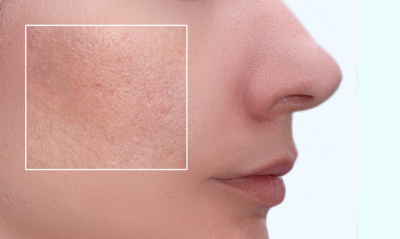 A zsíros bőr ápolása